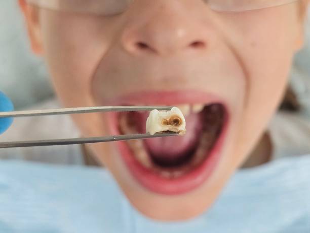 Best Emergency Treatment for Toothache in Burr Ridge, IL